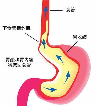 胃食管炎失眠怎么办治疗