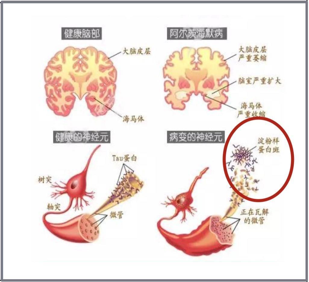 精神疾病