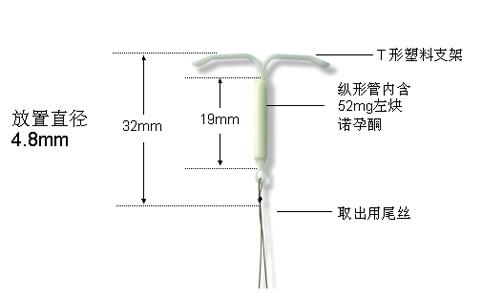 曼月乐环会引起抑郁吗 (曼月乐导致抑郁)