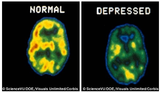 抑郁症大脑和正常人大脑的区别 (抑郁大脑与正常的区别)